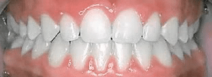 Before & After Orthodontist Prospect Lefferts Gardens NY