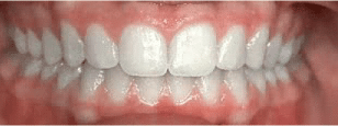 Teeth After Whitening