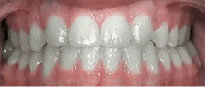 Teeth After Treatment