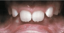 Teeth Problem