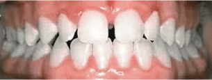 Spaces In Teeth
