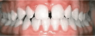 Before & After Spaces in Teeth