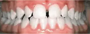 Spaces In Teeth