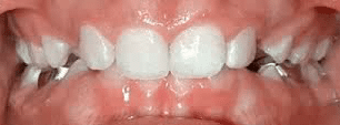 Before Teeth Problem