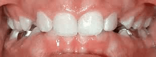 Before & After Before Teeth Problem