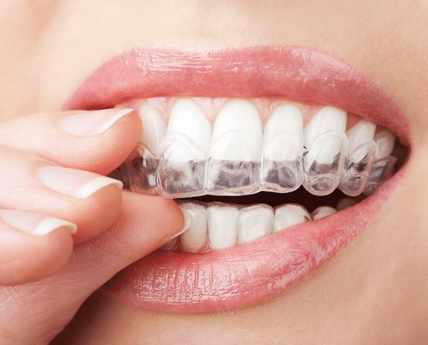 Invisalign Kings County Ny