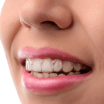 African American Invisalign Provider Nyc