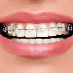 Clear Braces Park Slope Ny