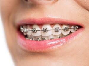 Foods To Eat With Braces