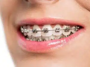 Life With Braces: Food To Eat With Braces Foods To Eat With Braces