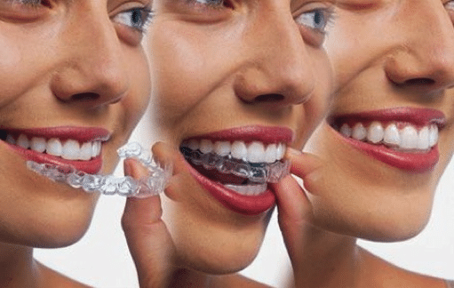 Invisalign Teen 11238