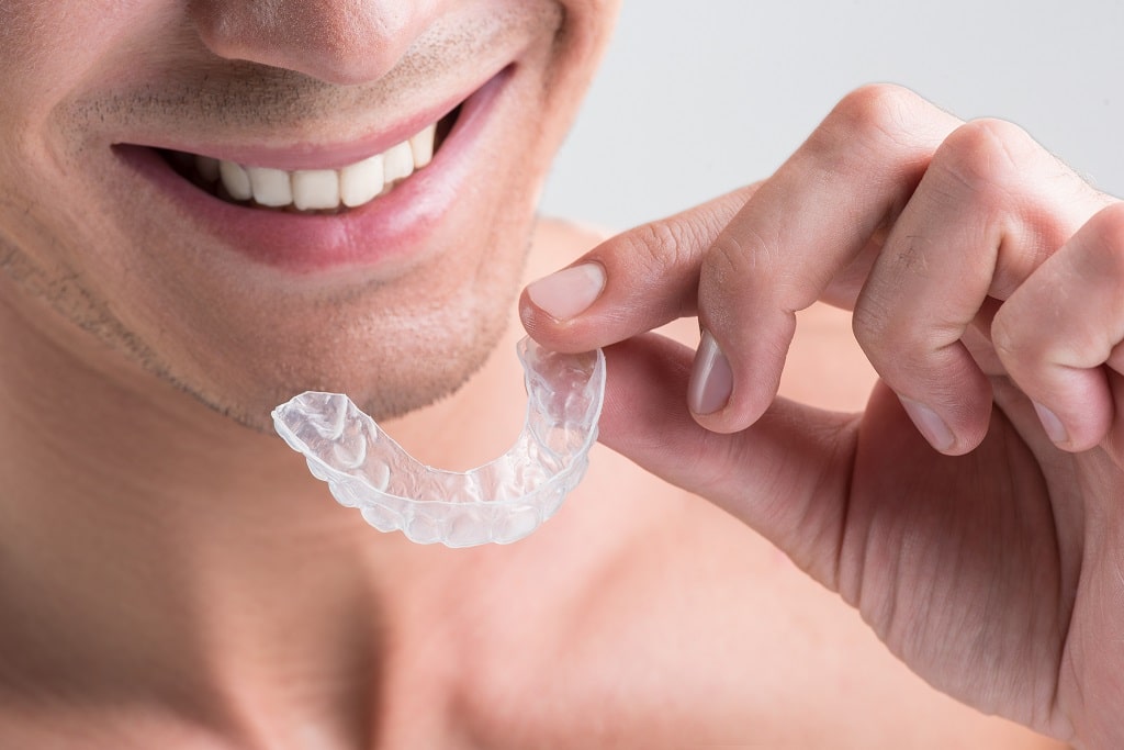 Are Diy Clear Aligners Effective