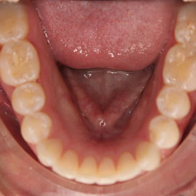 Invisalign Bottom