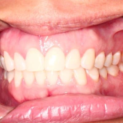 Invisalign Front Left Smile