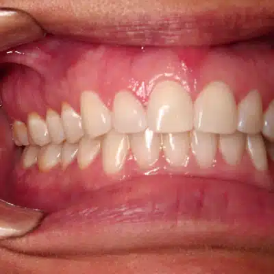 Invisalign Front Smile