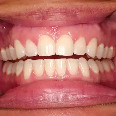 Invisalign For Adults Prospect Lefferts Gardens Ny