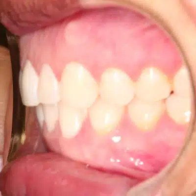 Invisalign Left