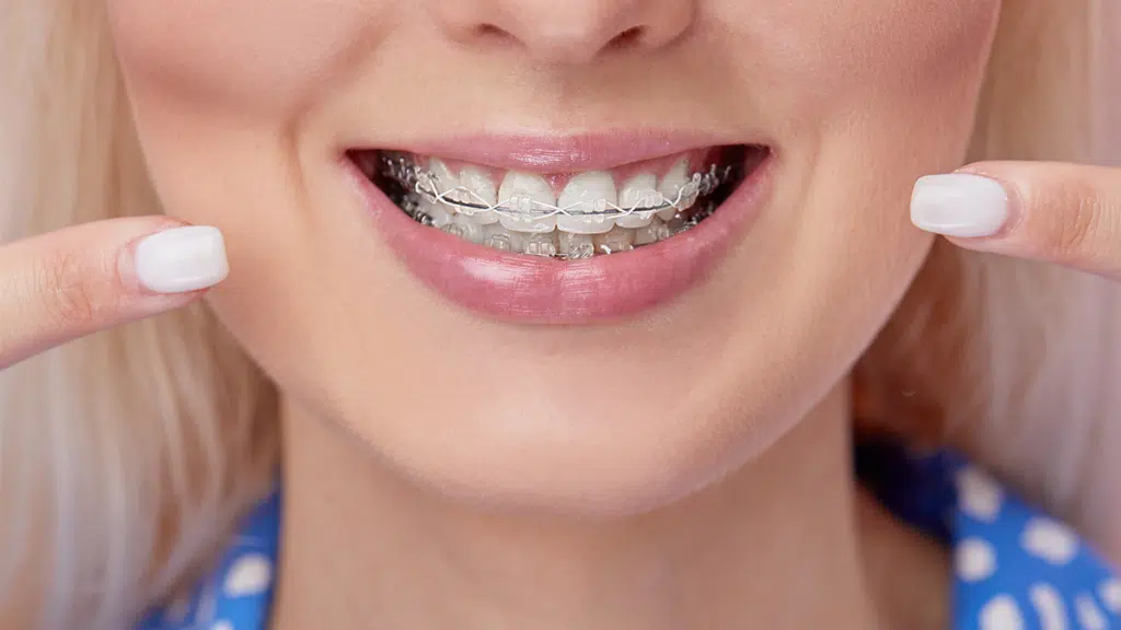 Braces Options, Clear