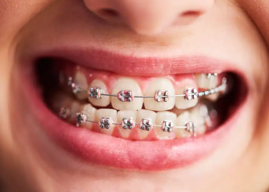 Braces In Brooklyn - Scantlebury Orthodontics