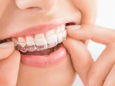 Invisalign Insurance