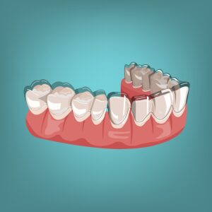 How Long Does Invisalign Take to Work? Timeline & More