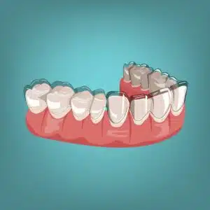 Invisalign Treatment Duration: What You Need To Know How Long Does Invisalign Take To Work? Timeline &Amp; More