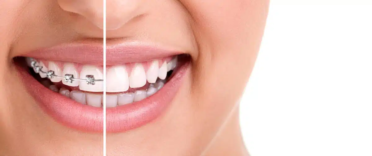 Benefits Of Wearing Braces: 5 Reasons To Consider Them