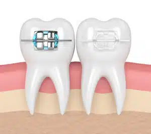 Benefits Of Wearing Braces: 5 Reasons To Consider Them