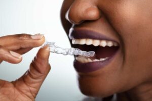 Invisalign Journey: The Ultimate Guide to a Perfect Smile
