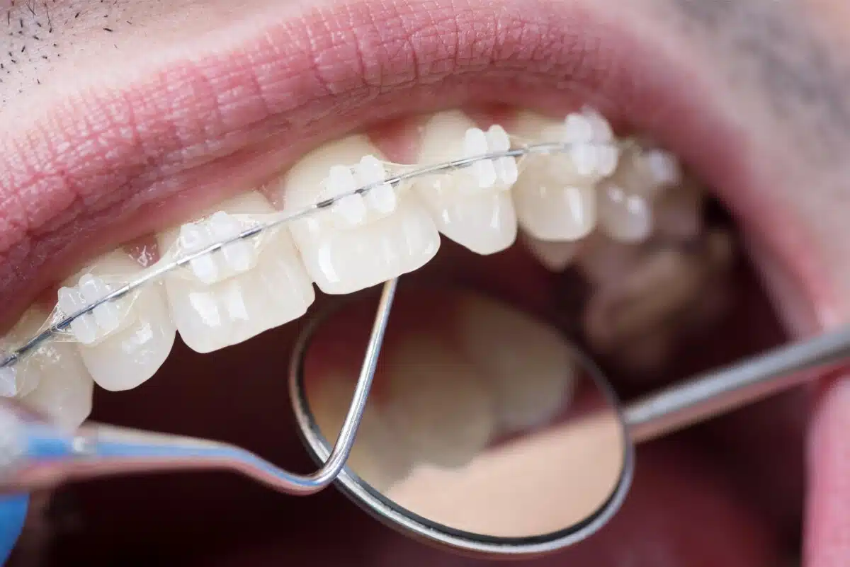 Ceramic Braces Treatment In Brooklyn Ny For A Confident Smile