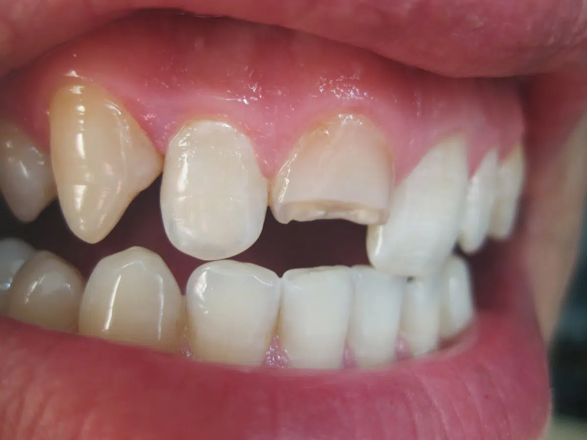 Cracked Or Broken Teeth