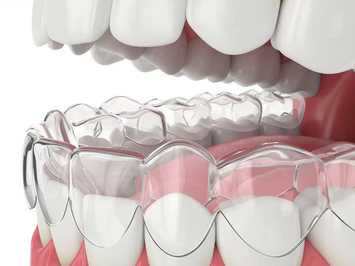 Close-up of Invisalign treatment on 3D dental model
