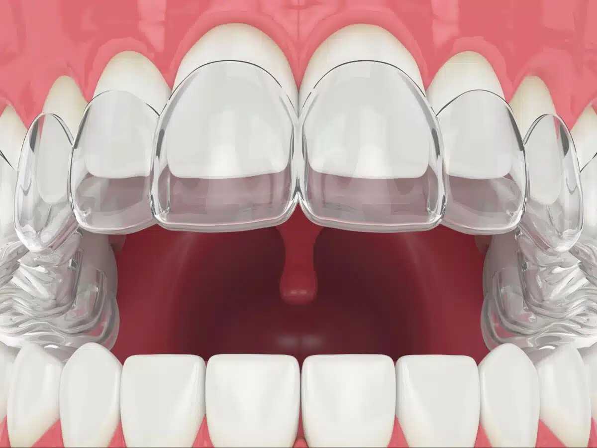 Invisalign for patients near Crown Heights NY at Scantlebury Orthodontics
